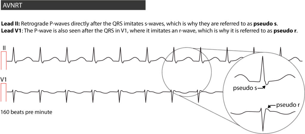 Figure 3. AVNRT in a 20-year old male suffering from palpitations.