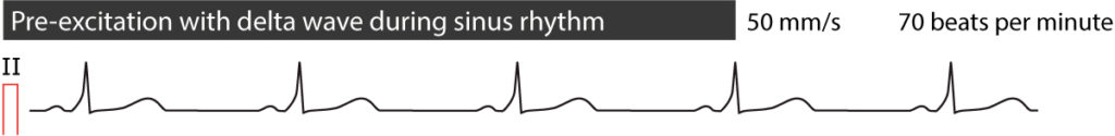 Figure 5. Pre-excitation during sinus rhythm.