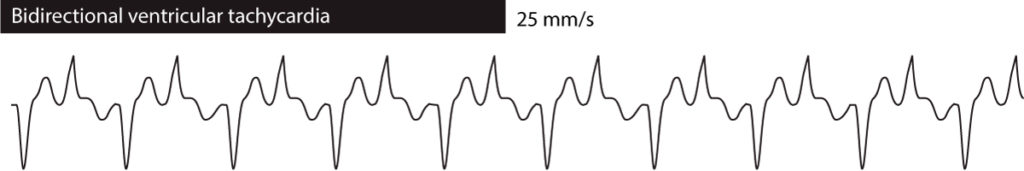 Figure 2. Bidirectional ventricular tachycardia