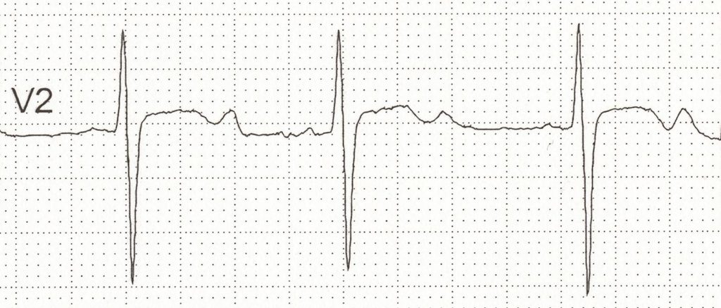 Figure 3. Hypokalemia.