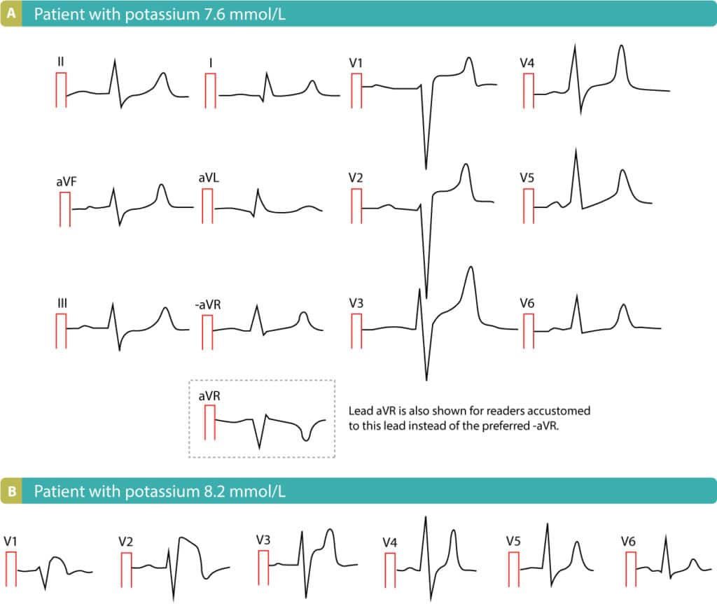 Figure 2. Two cases of hyperkalaemia.