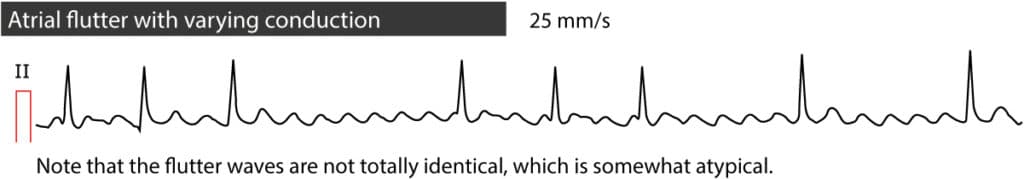 Figure 3. Atrial flutter with varying AV-block.