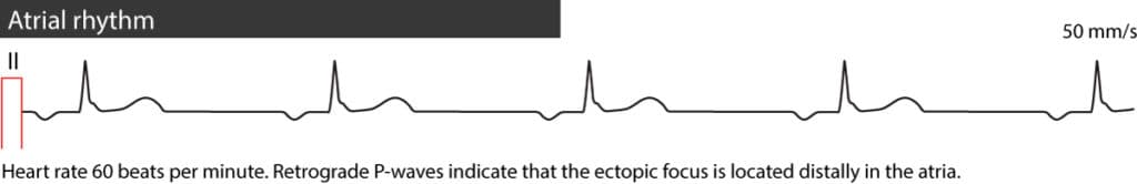 Figure 1. Atrial rhythm.