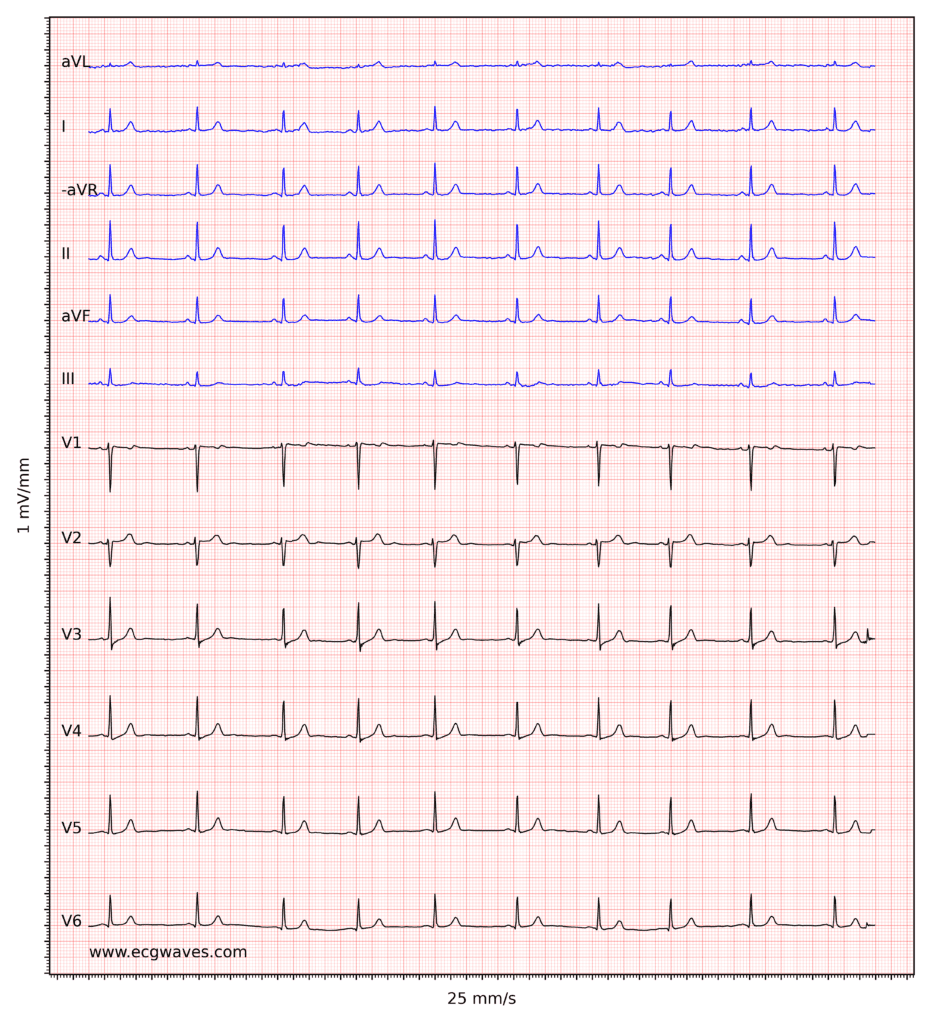 ECG example 3. Normal sinus rhythm. 
