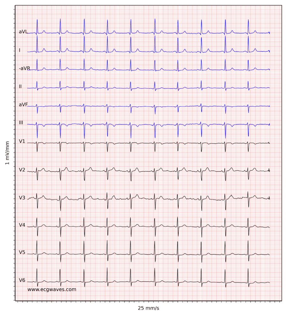 ECG example 5. Sinus rhythm. Negative T-waves in leads aVF and III. Discrete ST-segment depressions in leads V5-V6.