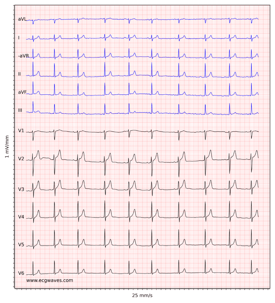 ECG example 7. Sinus rhythm.  Relatively large T-waves in V2-V3, with ST-segment elevations. Relative to the R-waves, T-waves are too large and pointed (differential diagnoses are considered below).