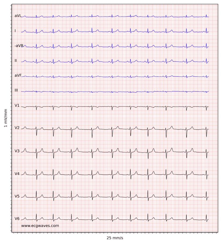 ECG example 2. Normal sinus rhythm. R-waves have low amplitude, suggesting low voltage (see below).