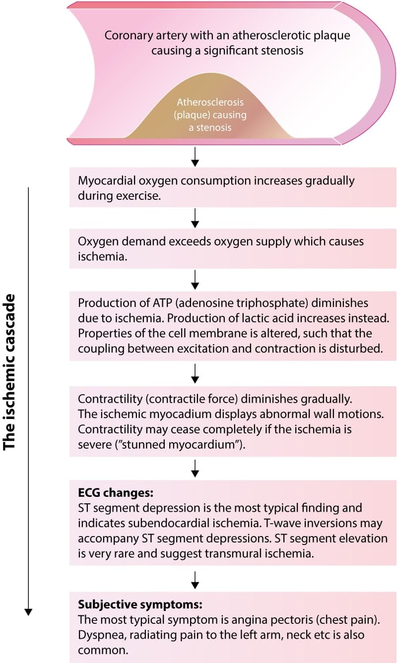 Figure 2. The ischemic cascade illustrates the course from ischemia to ECG changes and clinical symptoms. As illustrated, clinical symptoms (e.g chest pain) are the last events during an ischemic episode. It follows that myocardial ischemia may be present even in the absence of clinical symptoms. Moreover, the ECG detects more ischemic episodes than the patient reports.