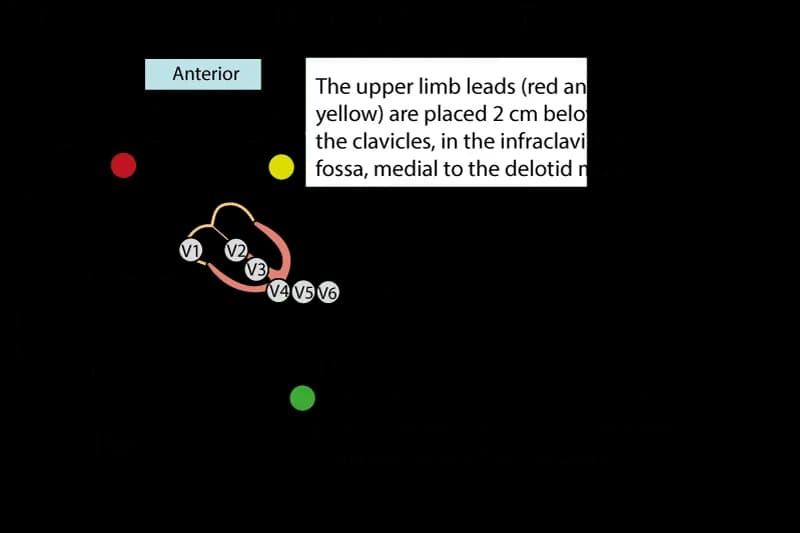 Figure 1. Lead placement for exercise ECG. Note that the precordial (chest) leads are placed normally. The limb leads are relocated to the torso, or proximally on the limbs. The lead placement depicted here is referred to as Mason-Likar's placement, with limb leads on the torso. This reduces artefacts (muscle disturbances) during exercise stress testing.