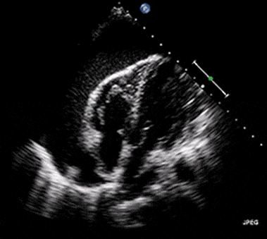 Video 1. Cardiac tamponade. The heart is surrounded by fluid (black) and swings back and forth in the fluid. One can also note that the right ventricular free wall is being compressed by the fluid.