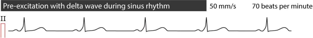 Figure 5. Pre-excitation during sinus rhythm.