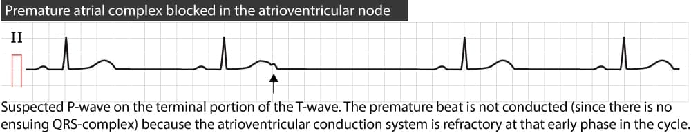 Figure 5. Premature atrial beat blocked in the atrioventricular node or bundle of His.