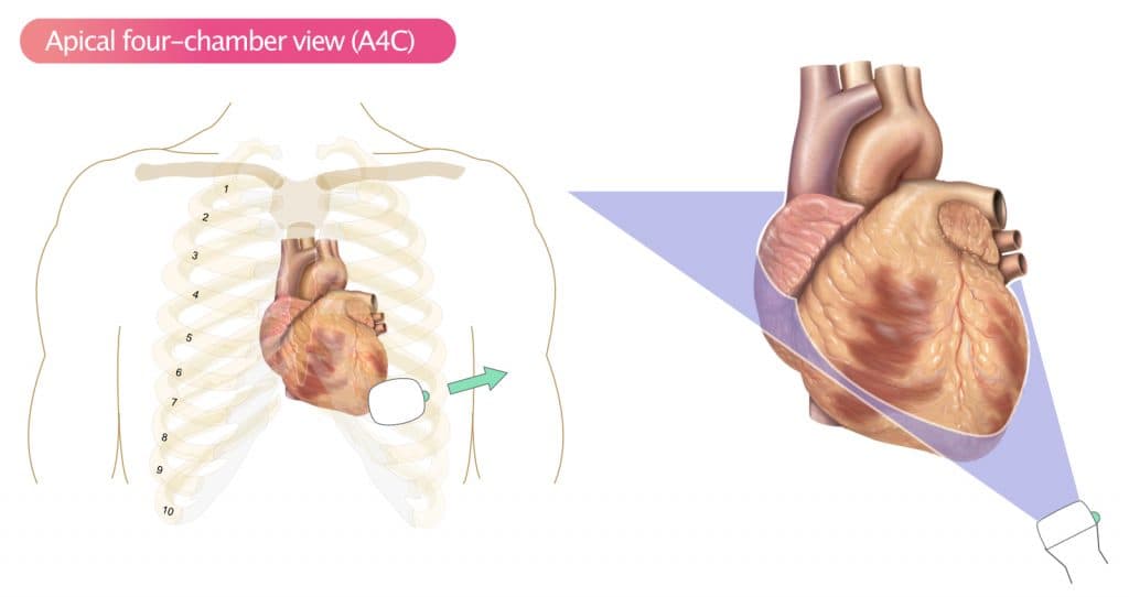 Figure 11. Apical four-chamber view (A4C).