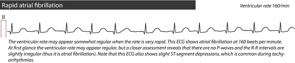 Figure 3. Rapid atrial fibrillation.