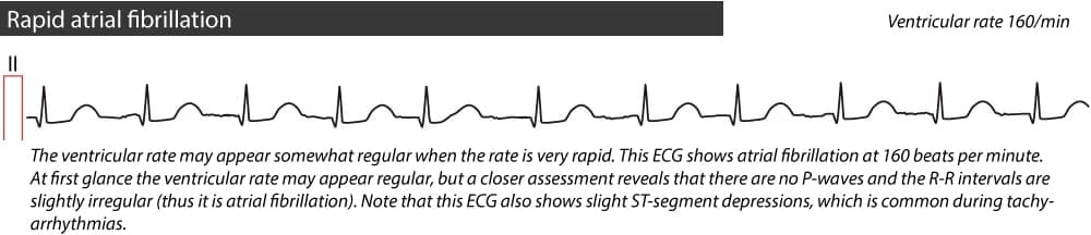Figure 3. Rapid atrial fibrillation.