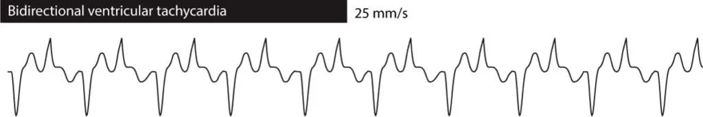 Figure 2. Bidirectional ventricular tachycardia