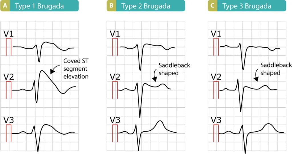 Figure 10. The three types of Brugada syndrome and the characteristic ST segment elevations.