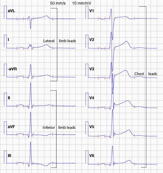Figure 19. The Cabrera format and inverted aVR.