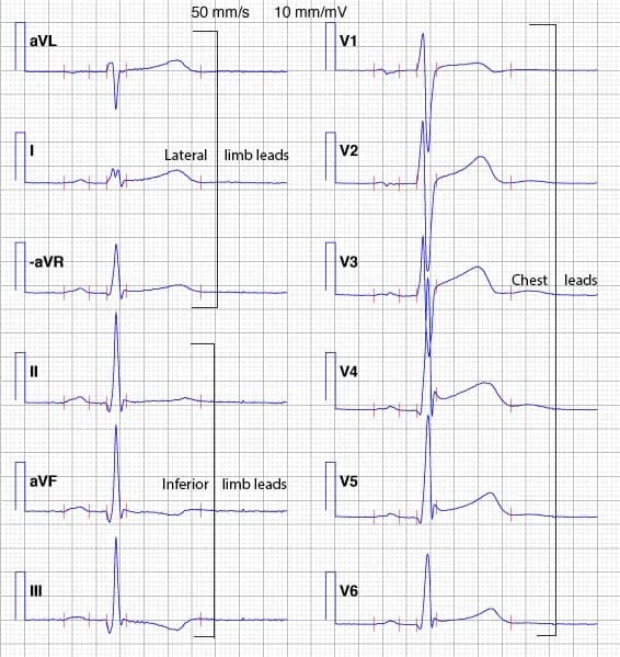 Figure 19. The Cabrera format and inverted aVR.