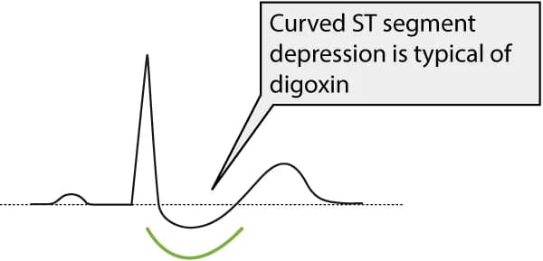 Figure 1. ST segment depression due to digoxin treatment.