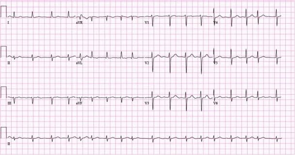 Figure 5. Example of 12-lead ECG with atrial fibrillation. Paperspeed: 25 mm/s.