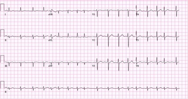 Figure 5. Example of 12-lead ECG with atrial fibrillation. Paperspeed: 25 mm/s.