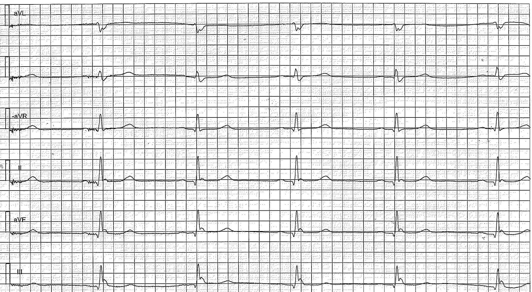 Figure 2. Limb leads showing early repolarization pattern. This patients brother died from sudden cardiac arrest at the age of 29. 