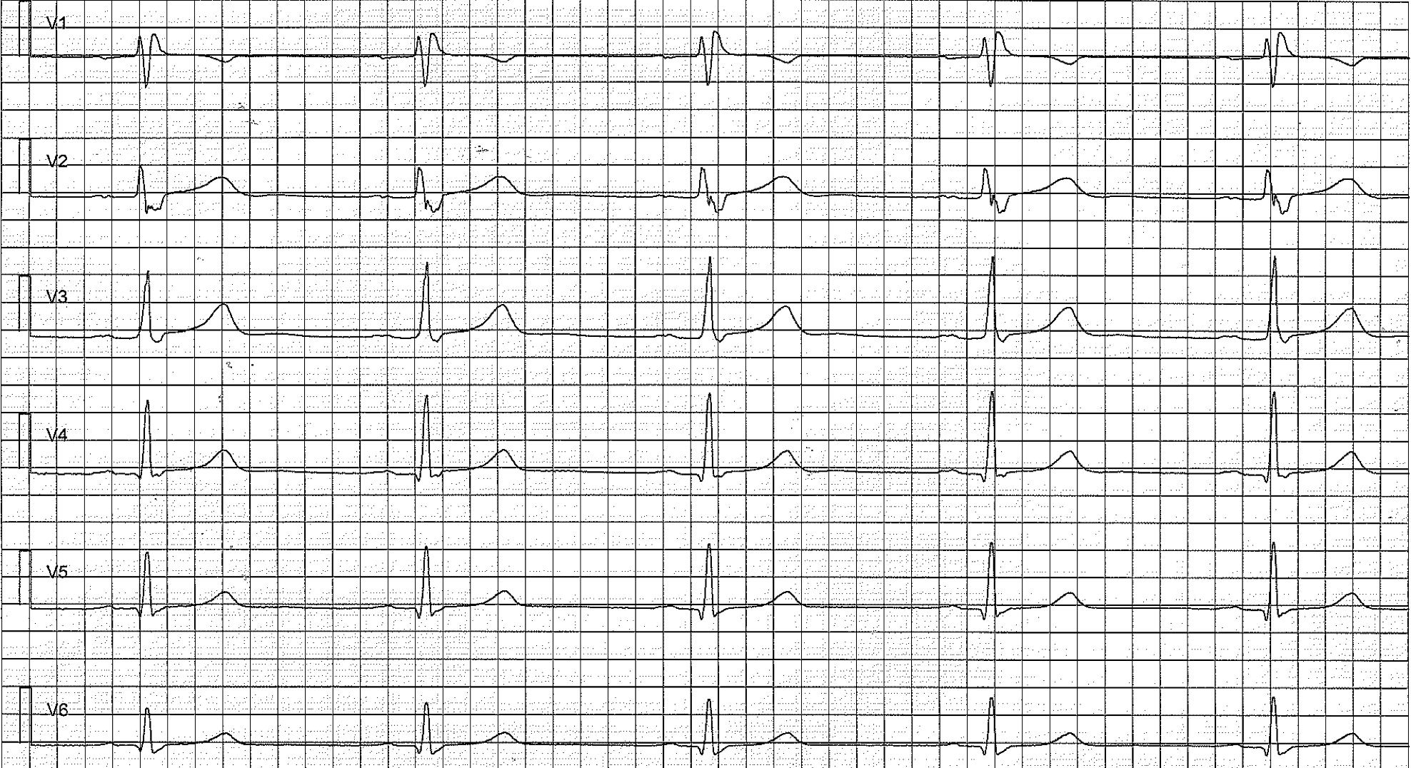 Figure 2. Chest (precordial) leads showing early repolarization pattern. This patients brother died from sudden cardiac arrest at the age of 29. Note the incomplete right bundle branch block (RBBB).