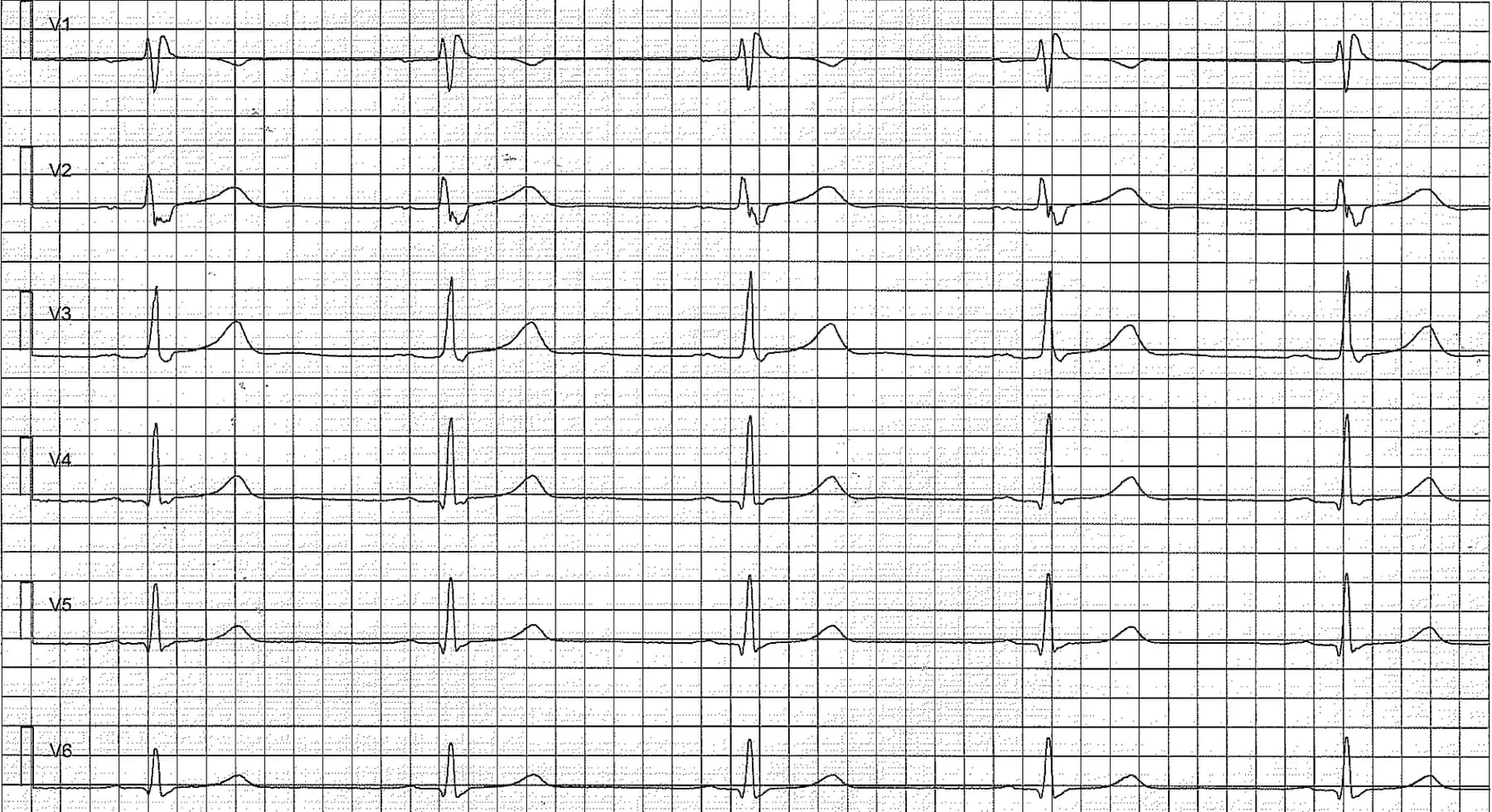 Figure 2. Chest (precordial) leads showing early repolarization pattern. This patients brother died from sudden cardiac arrest at the age of 29. Note the incomplete right bundle branch block (RBBB).