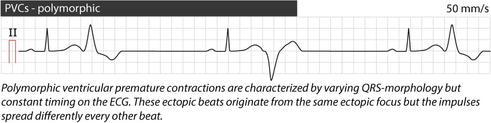 Figure 4. Polymorphic premature ventricular complexes (contractions).