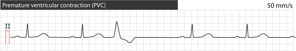 Figure 1. Premature ventricular contraction (complex/beat). Typical appearance. Note the paper speed 50 mm/s (1 large box equals 100 ms).