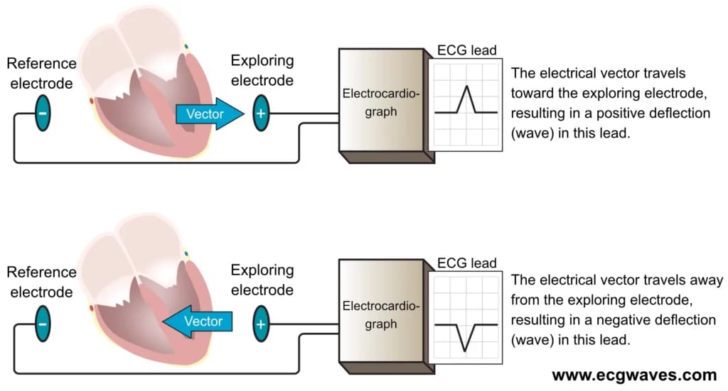 Figure 6. An ECG lead displays an ECG curve (diagram). At least two electrodes are necessary to obtain an ECG lead. One of the electrodes serves as reference and the other serves as exploring electrode. The electrocardiograph compares the electrical potentials detected in the electrodes. If a vectors travels towards the exploring electrode, and away from the reference electrode, a positive wave is printed.