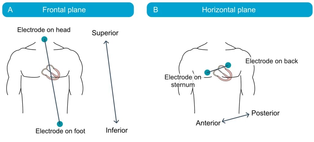 Figure 17. Schematic view of the angle of the limb and chest leads.