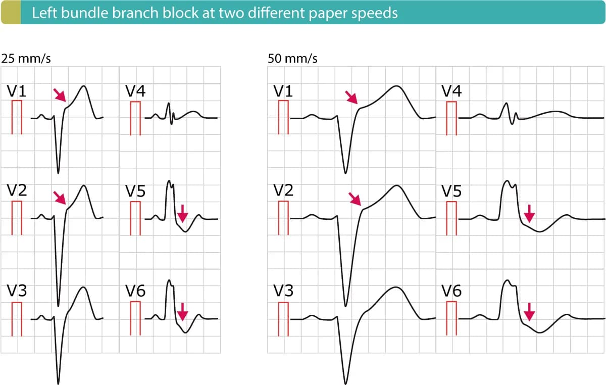 Figure 4. Left bundle branch block (LBBB) with typical ST elevations (V1–V2) and ST depressions (V5-V6).