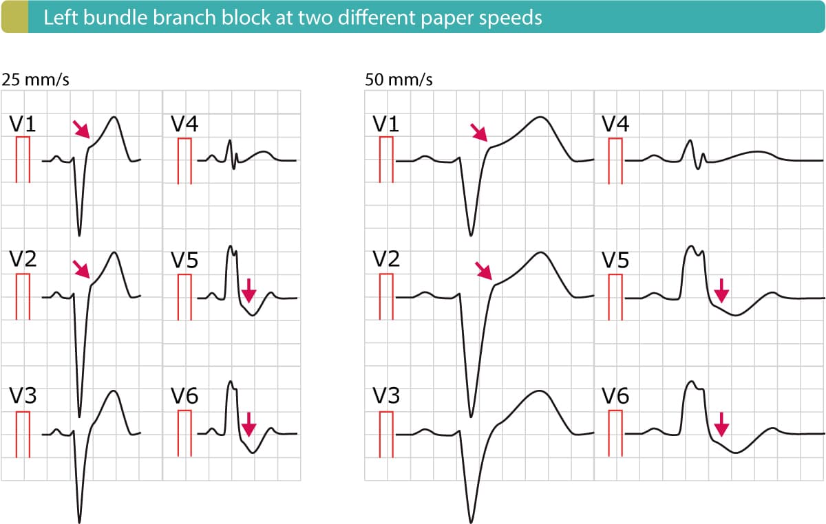 Figure 4. Left bundle branch block (LBBB) with typical ST elevations (V1–V2) and ST depressions (V5-V6).
