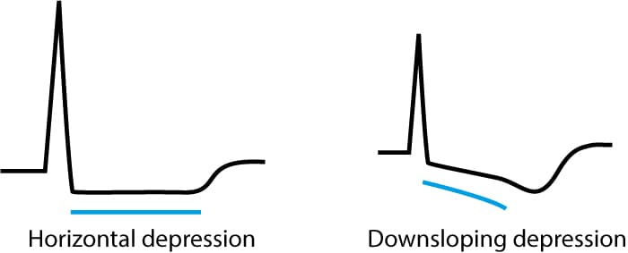 Figure 5. Characteristics of ischemic ST segment depressions.