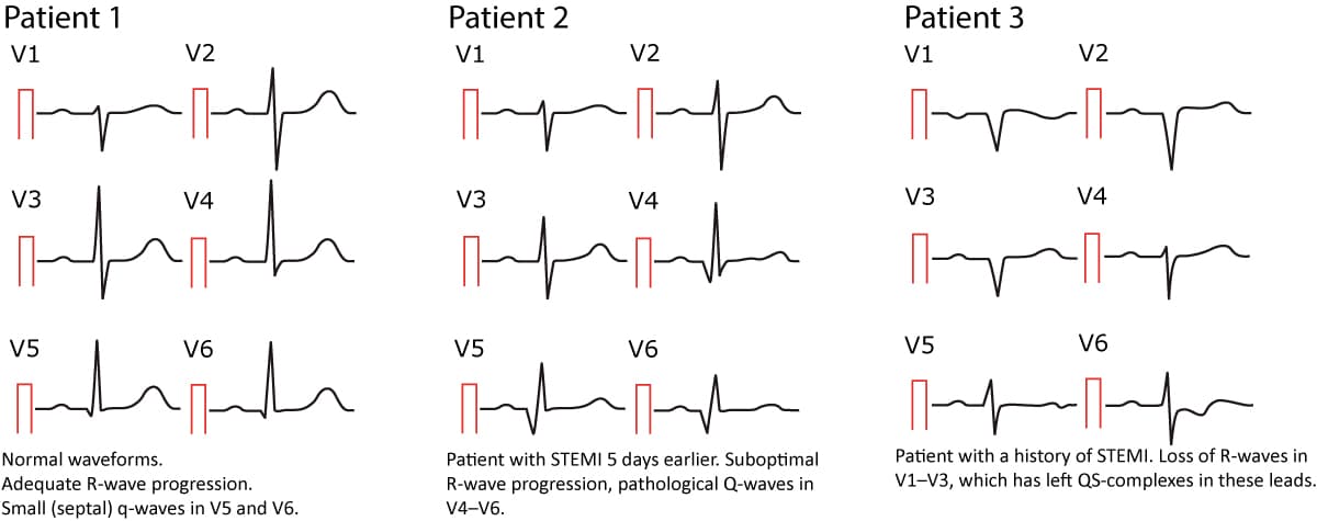 Figure 12. Normal and pathological Q-waves.