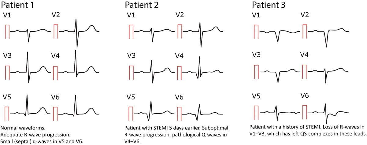 Figure 12. Normal and pathological Q-waves.