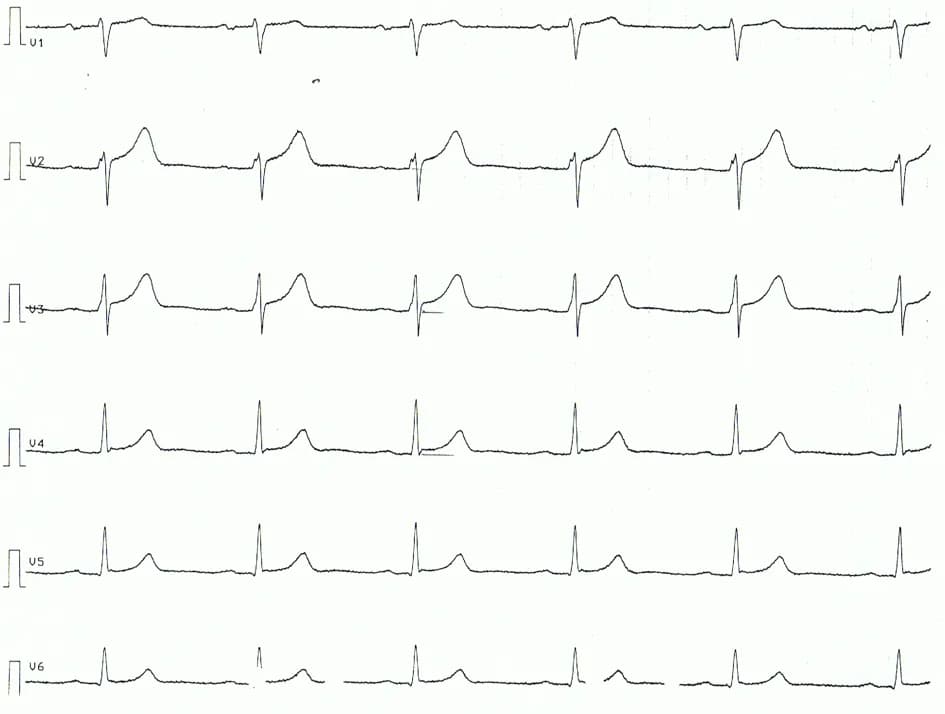 Figure 3. Chest leads of patient with acute pericarditis. Note the ST segment elevations, concave ST segments.