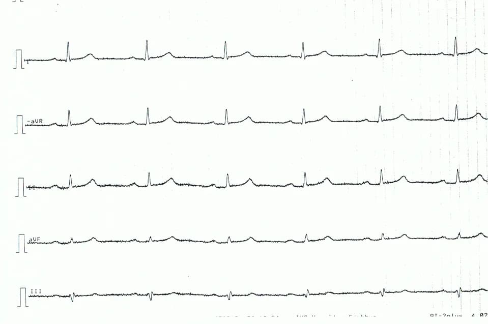 Figure 4. Limb leads of patient with acute pericarditis. Note the very discrete, but generalized, ST segment elevations, concave ST segments.