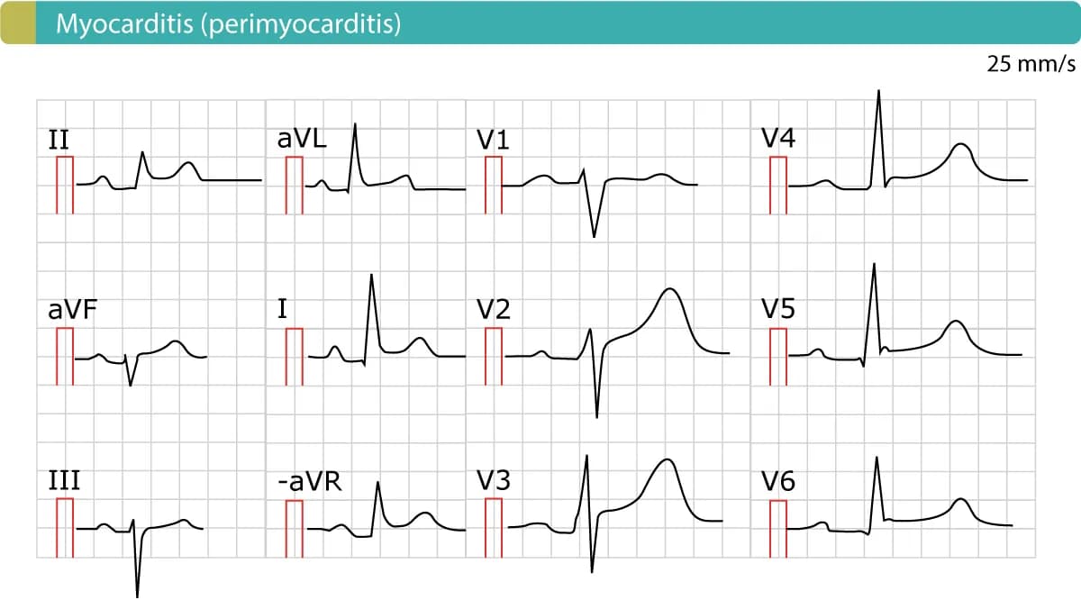 Figure 2. The ECG in acute pericarditis (myocarditis, perimyocarditis). As evident there are generalized ST segment elevations. There are no reciprocal ST segment depressions and no simultaneous T-wave inversions (negative T-waves).