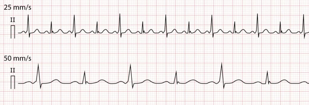 Figure 6. ECG displaying each and every beat conducted through an accessory pathway, which results in variations in QRS-amplitude.