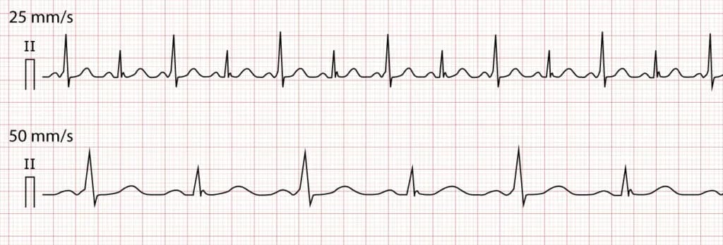 Figure 6. ECG displaying each and every beat conducted through an accessory pathway, which results in variations in QRS-amplitude.