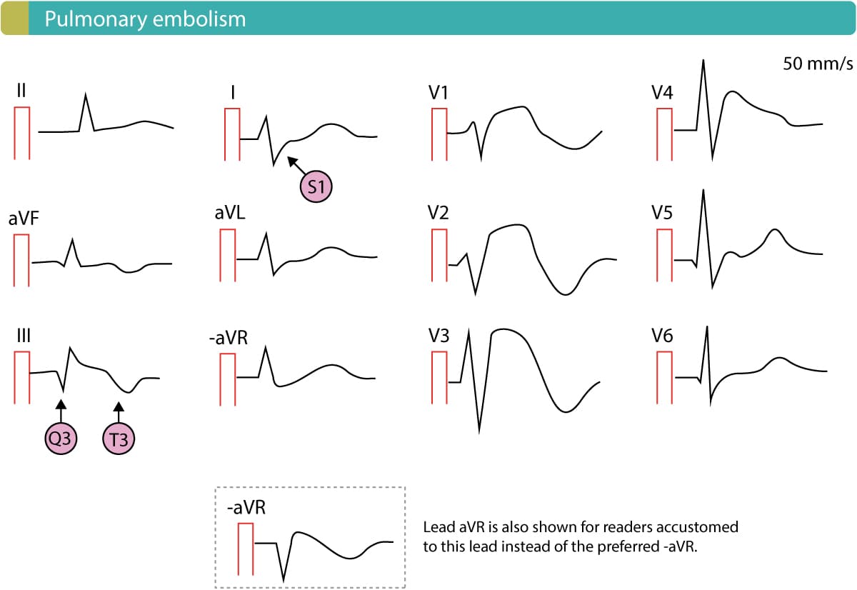 Figure 13. Pulmonary embolism with ST-segment elevations in right sided chest leads.