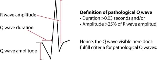 Figure 11. Criteria for pathological Q-waves.