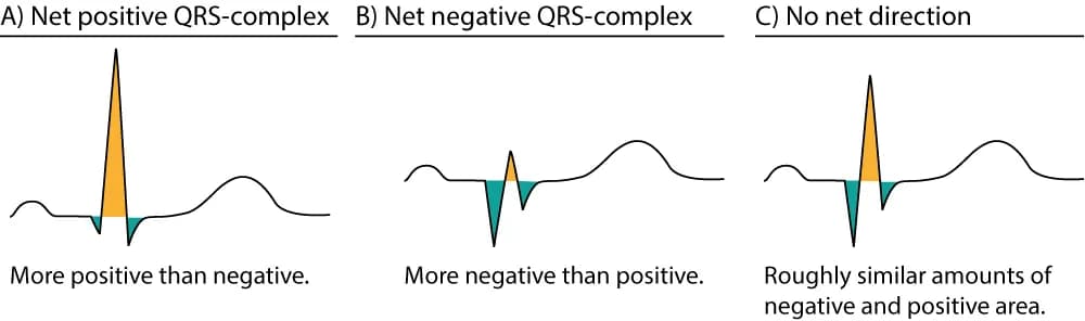 Figure 6. Approximations of the net direction of the QRS-complex. The positive areas are yellow and the negative areas are green.