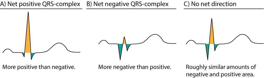 Figure 6. Approximations of the net direction of the QRS-complex. The positive areas are yellow and the negative areas are green.