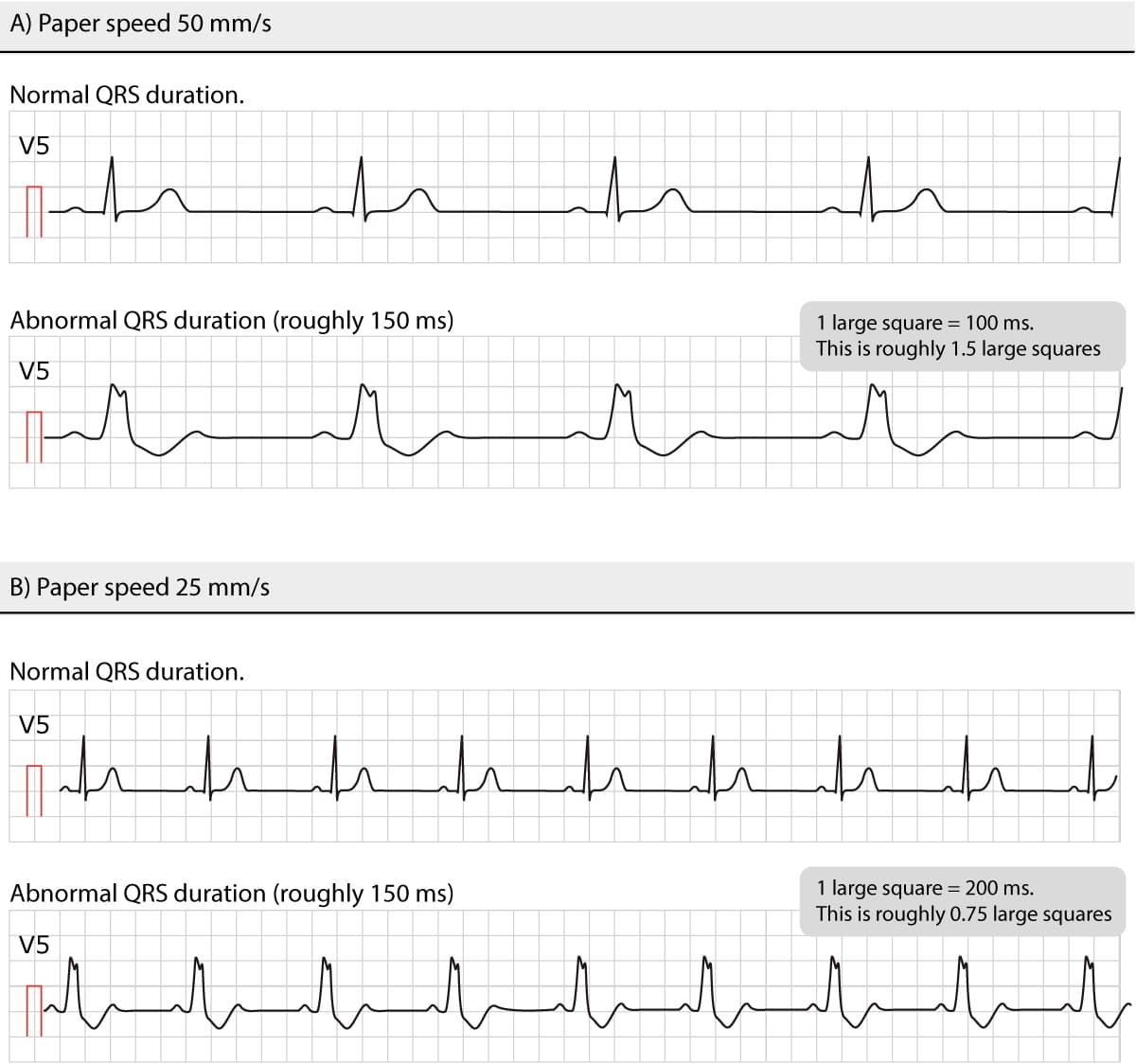Figure 8. Normal and abnormal QRS durations at different paper speeds.