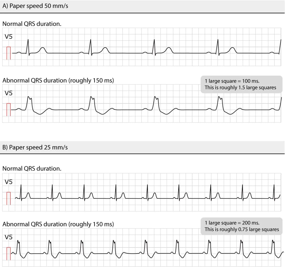 Figure 8. Normal and abnormal QRS durations at different paper speeds.