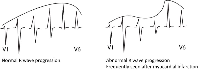Figure 10. Normal and abnormal R-wave progression.